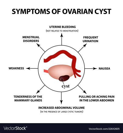 Symptoms Of Ovarian Cyst Ovaries Structure Vector Image