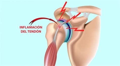 Lesiones Principales De Hombro Tendinitis Del Biceps Fisioterapia The Best Porn Website