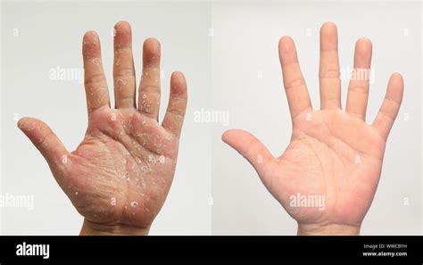 Psoriasis On Hands And Feet