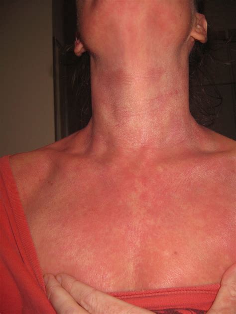 Topical Steroid Withdrawal Journey Healing Eczema And Red Skin Syndrome