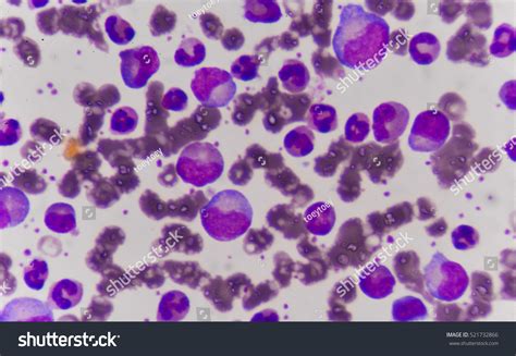 Blast Cells Leukemia Stock Photo 521732866 Shutterstock