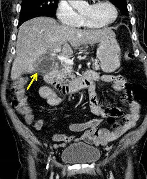 Ruptured Gallbladder Empyema Radiology Cases