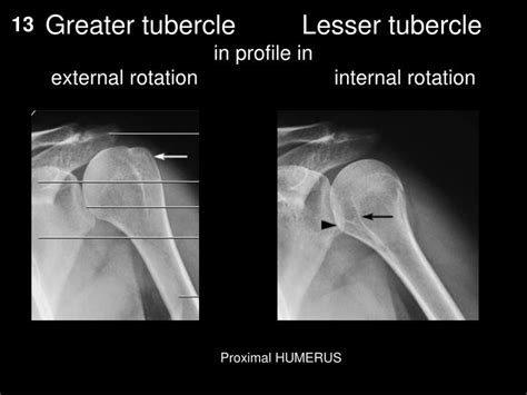 It is situated in front, and is directed medially and anteriorly. PPT - More upper extremity PowerPoint Presentation - ID ...