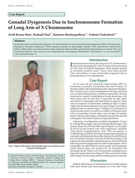 gonadal dysgenesis due to isochromosome formation of long arm