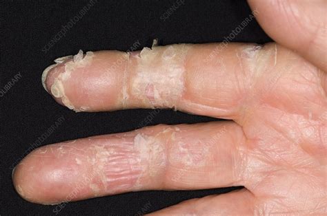 Exfoliative Dermatitis On The Hand Stock Image C0069153 Science