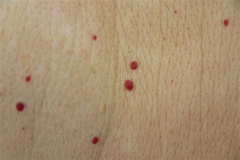 Red Spots On Skin And Kidney Disease