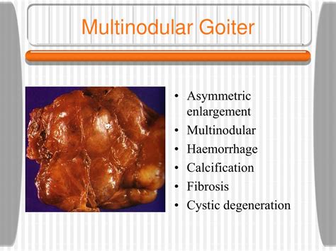 Ppt Pathology Of The Thyroid Gland Powerpoint Presentation Id257650