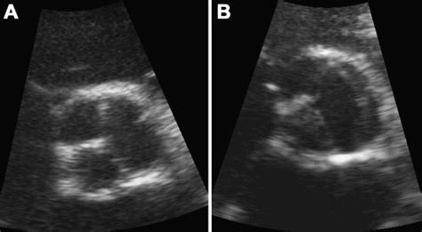 Quadricuspid Aortic Valve A Rare Clinical Entity Heart Lung And