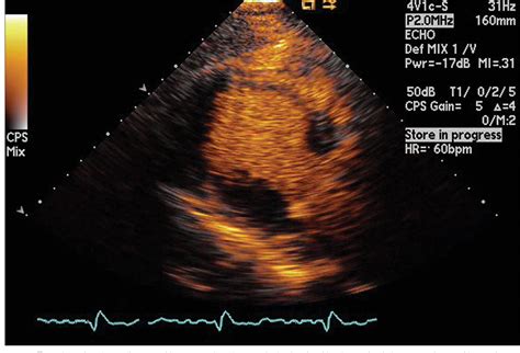 Figure From Recurrent Transient Apical Cardiomyopathy Tako Tsubo