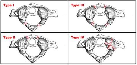 Types Of Vertebral Fractures