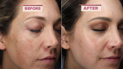 How To Get Rid Of Melasma According To Ginger Zees Dermatologist