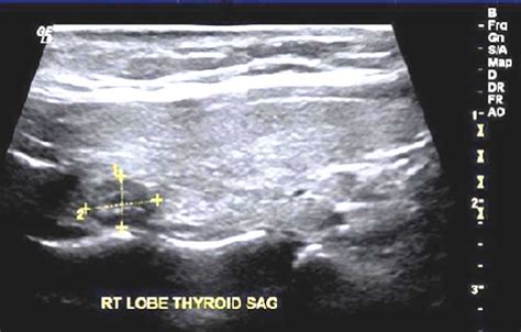 Thyroid Ultrasound Showing Well Defined Hypoechoic Lymph Nodes