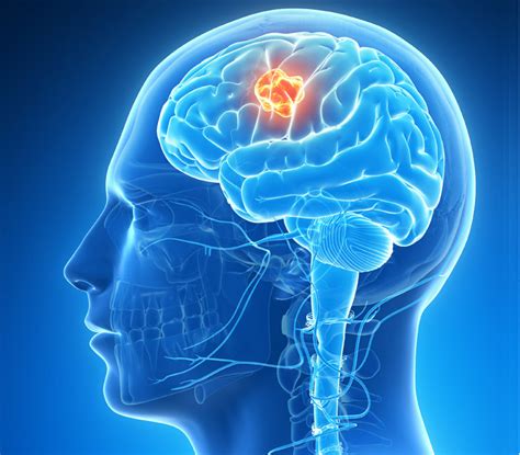 Research Boost For Deadly Brain Cancer