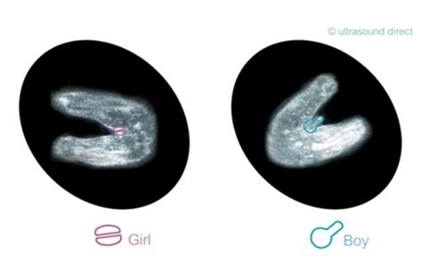 The technology used in an ultrasound allows moms and doctors to get a glimpse of the baby growing in the womb, even when the baby is the size of a cherry. Do 3 lines on an ultrasound mean it's a girl? | Baby ...