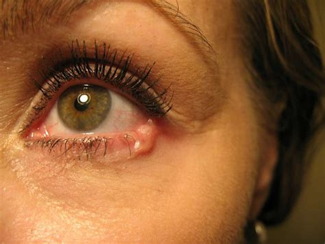 Skin Cancer Pesky Eyelid Symptom Requires Surgery