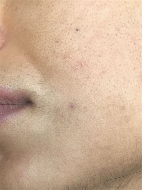 Acne What Are These Tiny Bumps On My Face They Are Filled With Fluid