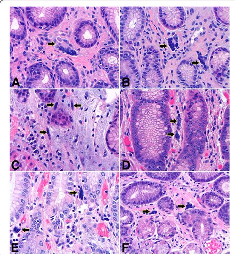 Histological Features Of Multinucleated Stromal Giant Cells A And B