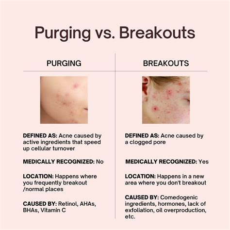 Skin Purging Vs Breakout How To Tell The Difference Artofit