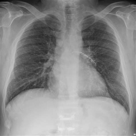 Chest X Ray Showing Linear Opaque Lesion In Left Pulmonary Artery