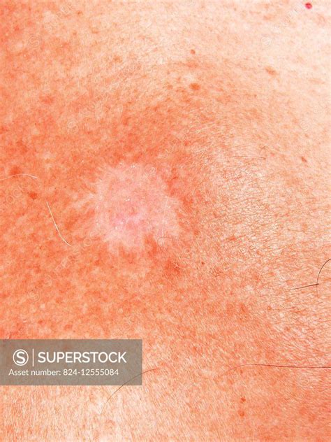 Nodular Basal Cell Carcinoma On The Shoulder Stock Photo 824 12555084