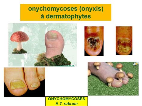 Dermatologie Mycoses Superficielles Youtube