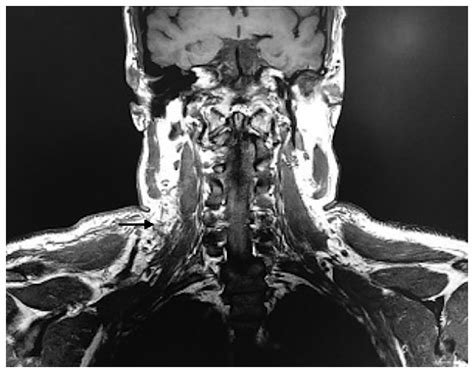 Mri Of The Neck Coronal Section There Is Evidence Of Diffuse Edema Of