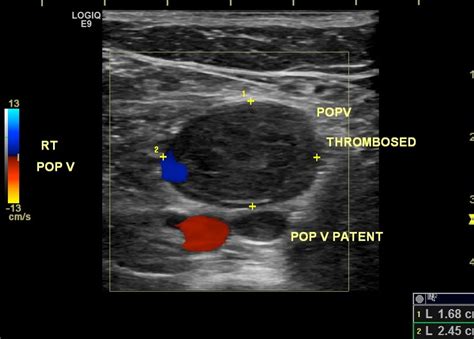 Lung Ultrasound For Pulmonary Embolism Critical Care Sonography