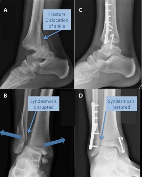 Displaced Trimalleolar Ankle Fracture