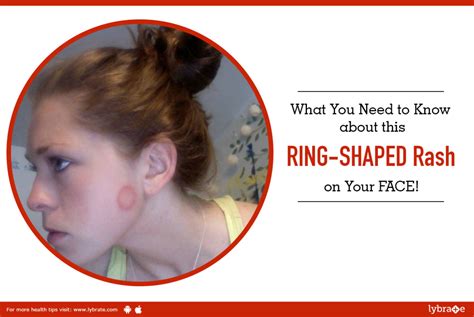 What You Need To Know About This Ring Shaped Rash On Your Face By Dr
