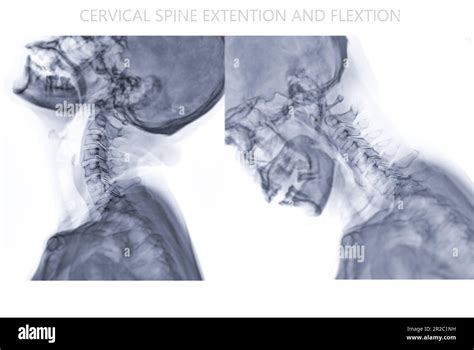 Radiographie Du Rachis Cervical Ou Image Radiographique De La Flexion