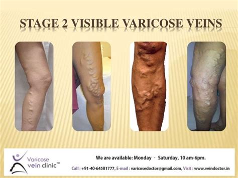 Know About Varicose Veins Best Treatment For Varicose Veins