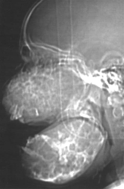 Imaging Characteristics Of Cherubism Ajr