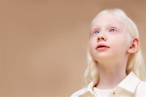 Albino Cute Little Girl With Albinism Syndrome Stock Photo Image Of