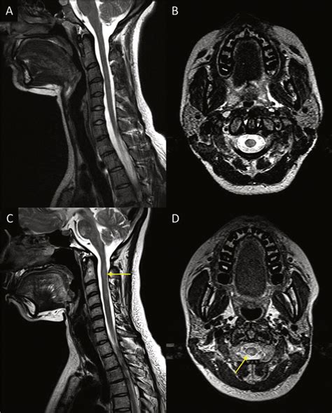 Spine Imaging T2 Weighted Imaging Covering The Cervical