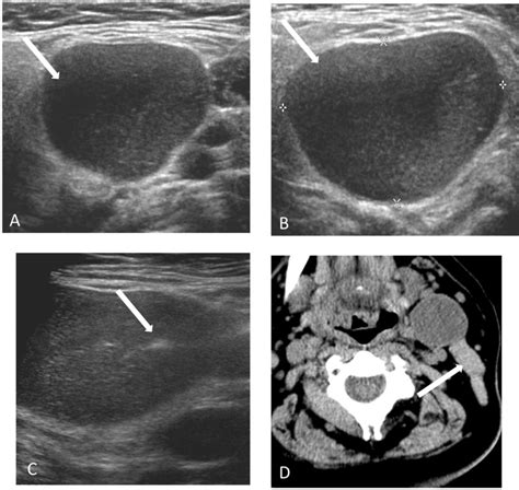 Infected Left 2nd Branchial Cleft Cyst A Gray Scale Axial And B