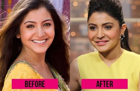 Anushka Sharma Had A Plastic Surgery Know About Her Relationship And