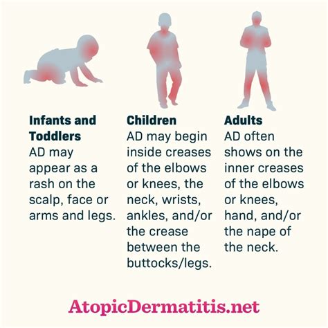 Used With Permission From Health Union Llc 2017 Atopic Dermatitis