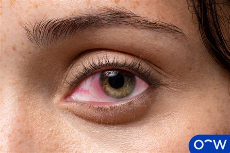 Eye Allergies Types Causes Symptoms And Treatments