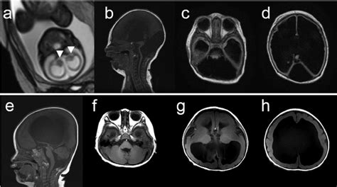 Brain Mri Findings Of Two Patients With Mutations In Tuba1a A