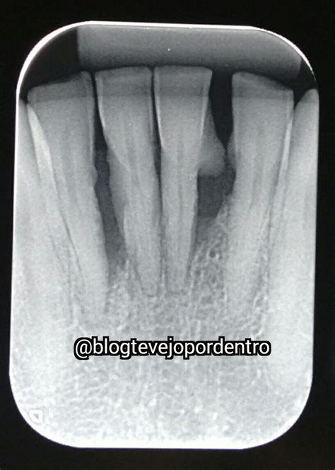 Te Vejo Por Dentro Paciente Periodontal