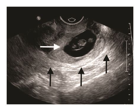 Transvaginal Ultrasound Showing A Live Ectopic Pregnancy White Arrow