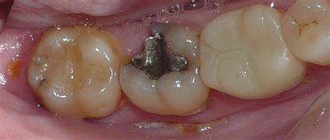 Broken Teeth Beverly Restorative And Implant Dentistry Center
