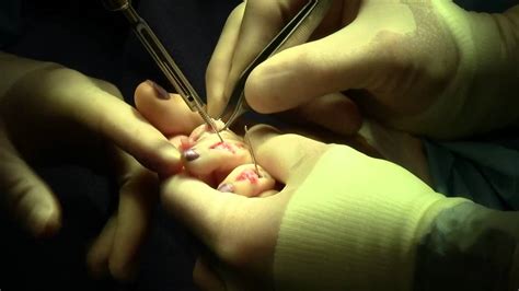 Dr Sherman Nagler Hammer Toe Surgery With A Diuse