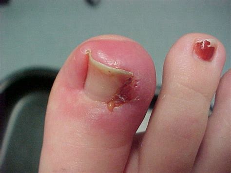 Ingrown Toenail Treatment Surgery Removal Remedies Causes Home