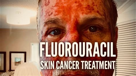 Fluorouracil Skin Treatment Before During And After Youtube