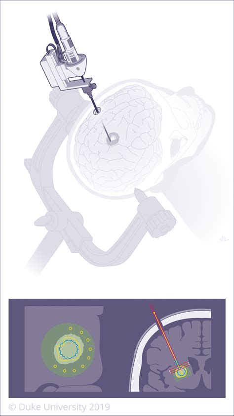 Laser Interstitial Thermal Therapy Litt Involves Inserting A Laser Download Scientific