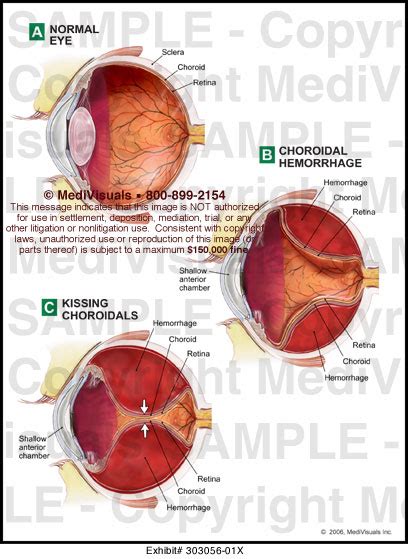 Medivisuals Pathological Conditions Of The Choroid Medical Illustration