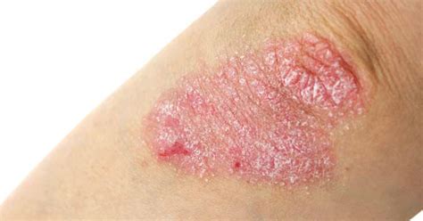 5 Home Remedies For Eczema That Will Relieve Itchiness
