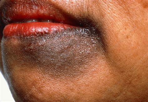 Chloasma Liver Spot Affecting A Womans Chin Stock Image M130