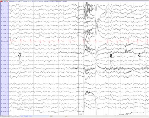Benign Childhood Epilepsy With Centrotemporal Spikes Bects Or